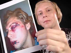 Chaz Housand Paul Stephen photo Chaz Housand shows gay bashing injuries (Paul Stephen photo for StarNewsOnline)